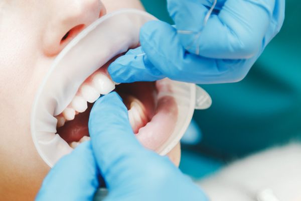 Dentistul îi de lui Bulă o gură de țuică: Cum te simţi?